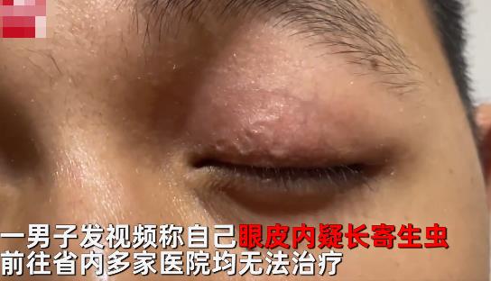 男子左眼皮异常抖动有虫游走 眼皮上怎么会有虫?