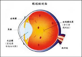 玻璃体病变引起飞蚊症