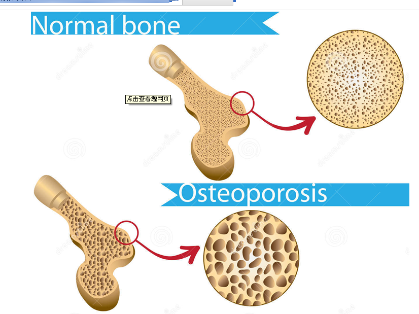 骨质疏松