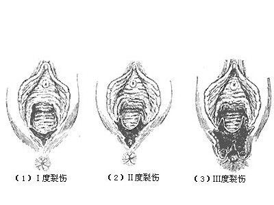 产后阴道恢复