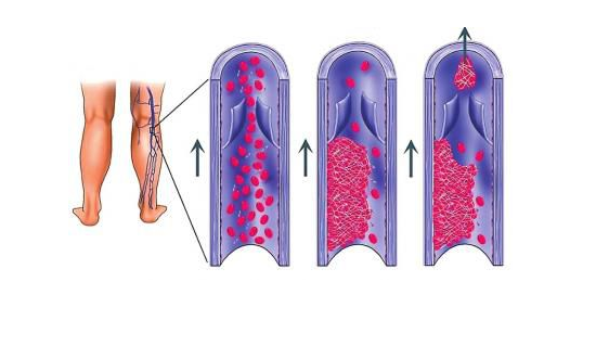静脉血栓的症状表现