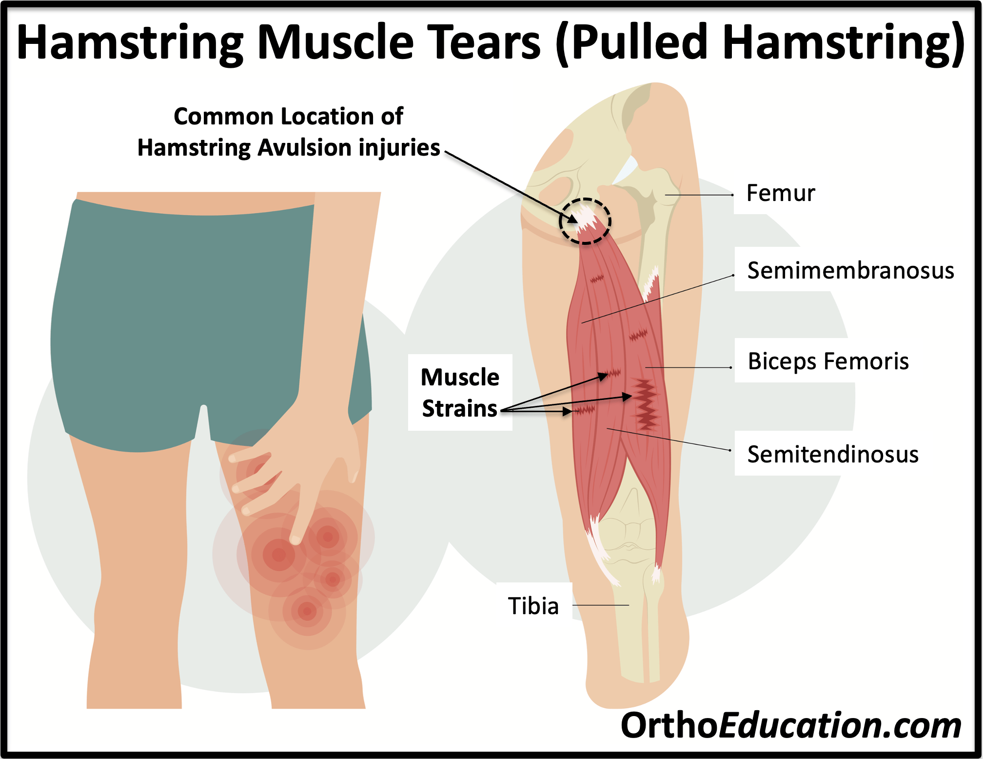 Hamstring-Muscle-Tears-Pulled-Hamstring.png