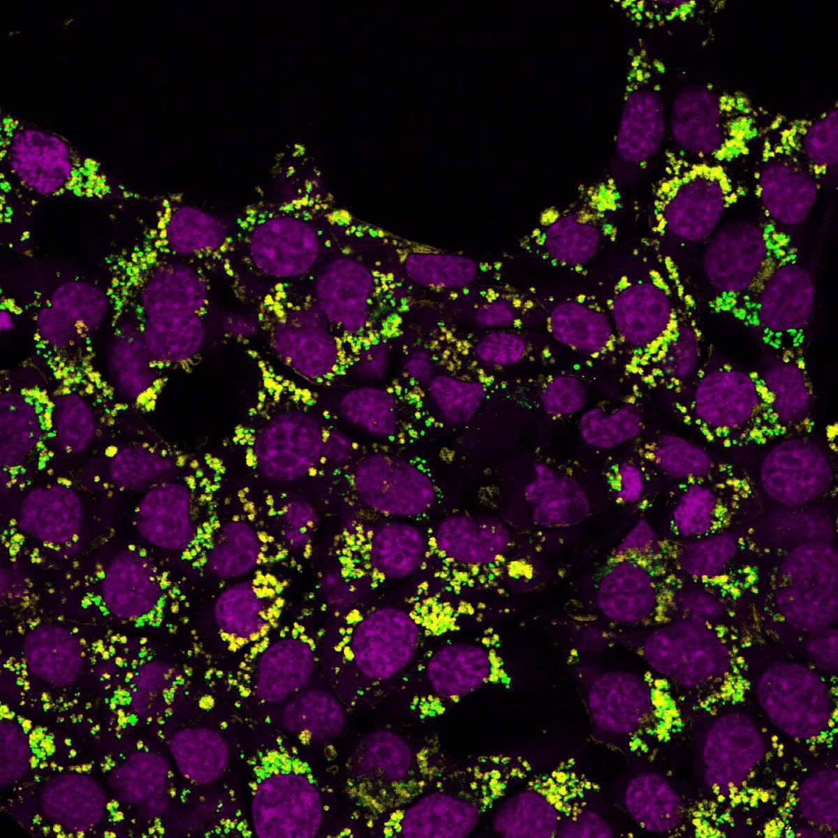 Fluorescent-Cholesterol-Signals-in-Cancer-Cells.jpg