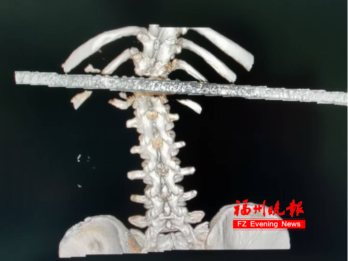 紧急救援！女子从6楼坠落，钢筋穿腰，胸椎骨折！手术做了6个小时……