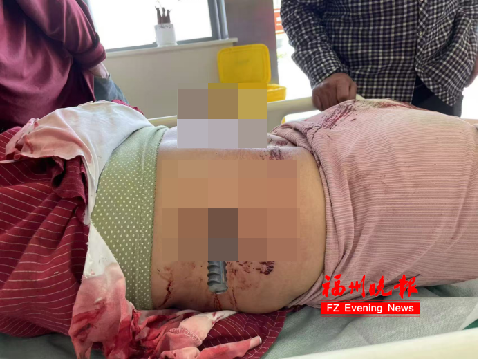 紧急救援！女子从6楼坠落，钢筋穿腰，胸椎骨折！手术做了6个小时……