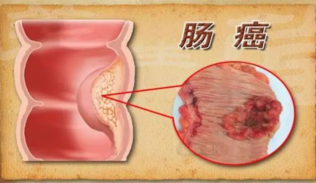 哨兵痔手术肛门处有刀口吗_哨兵痔手术 肛门失禁 怎么办_哨兵痔手术后好久能恢复