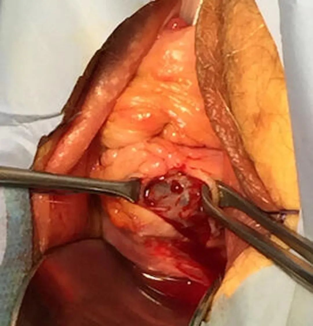 肛门失禁能治疗吗_肛门失禁可以痊愈吗_肛门失禁能自愈吗