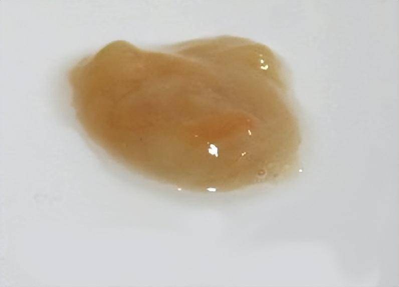 呼吸合胞病毒表现_呼吸道合胞病毒的缩写_呼吸道合胞病毒缩写