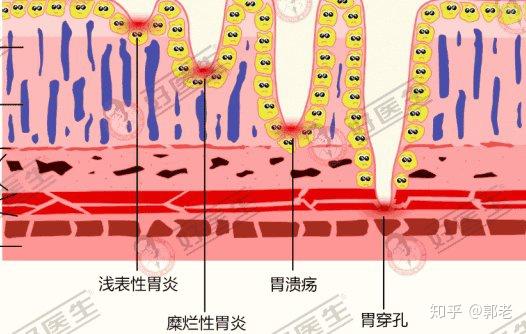 治疗胃浅表性胃炎的药_浅表性胃炎西药_浅表性胃炎用什么药