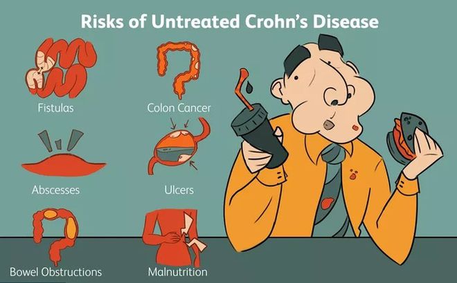 克罗恩类克贵吗_类克克罗恩_克罗恩类克多少钱一针