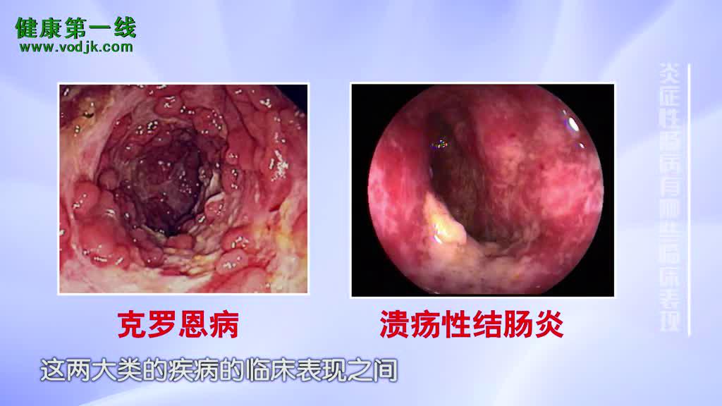 克罗恩代病_罗克罗恩病_罗克恩病早期症状
