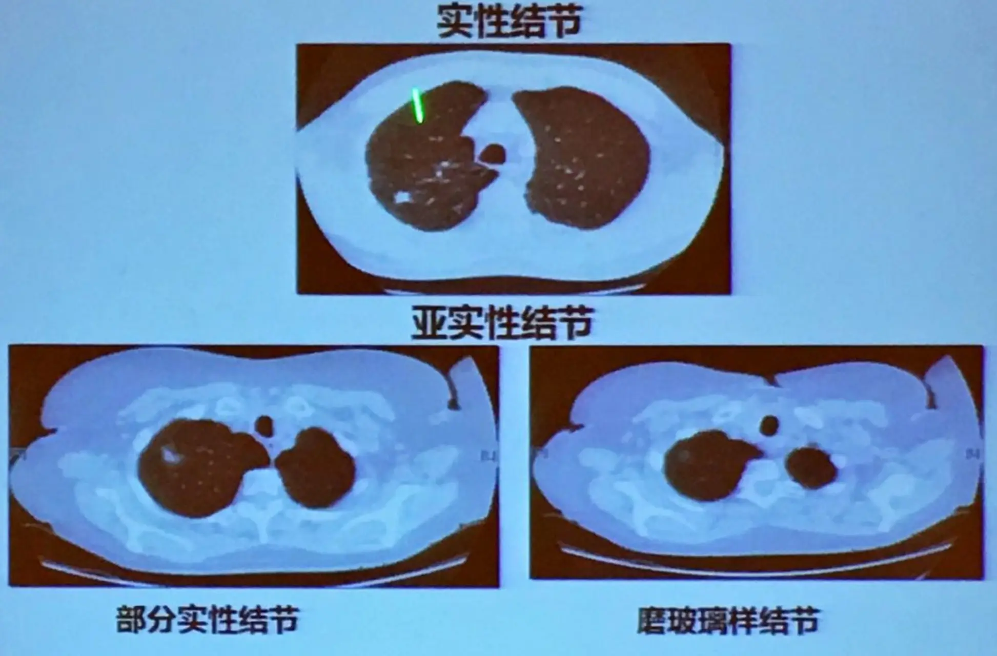 慢性肺炎吃什么好_慢性肺炎治疗期间什么食物好_慢性肺炎需要吃什么