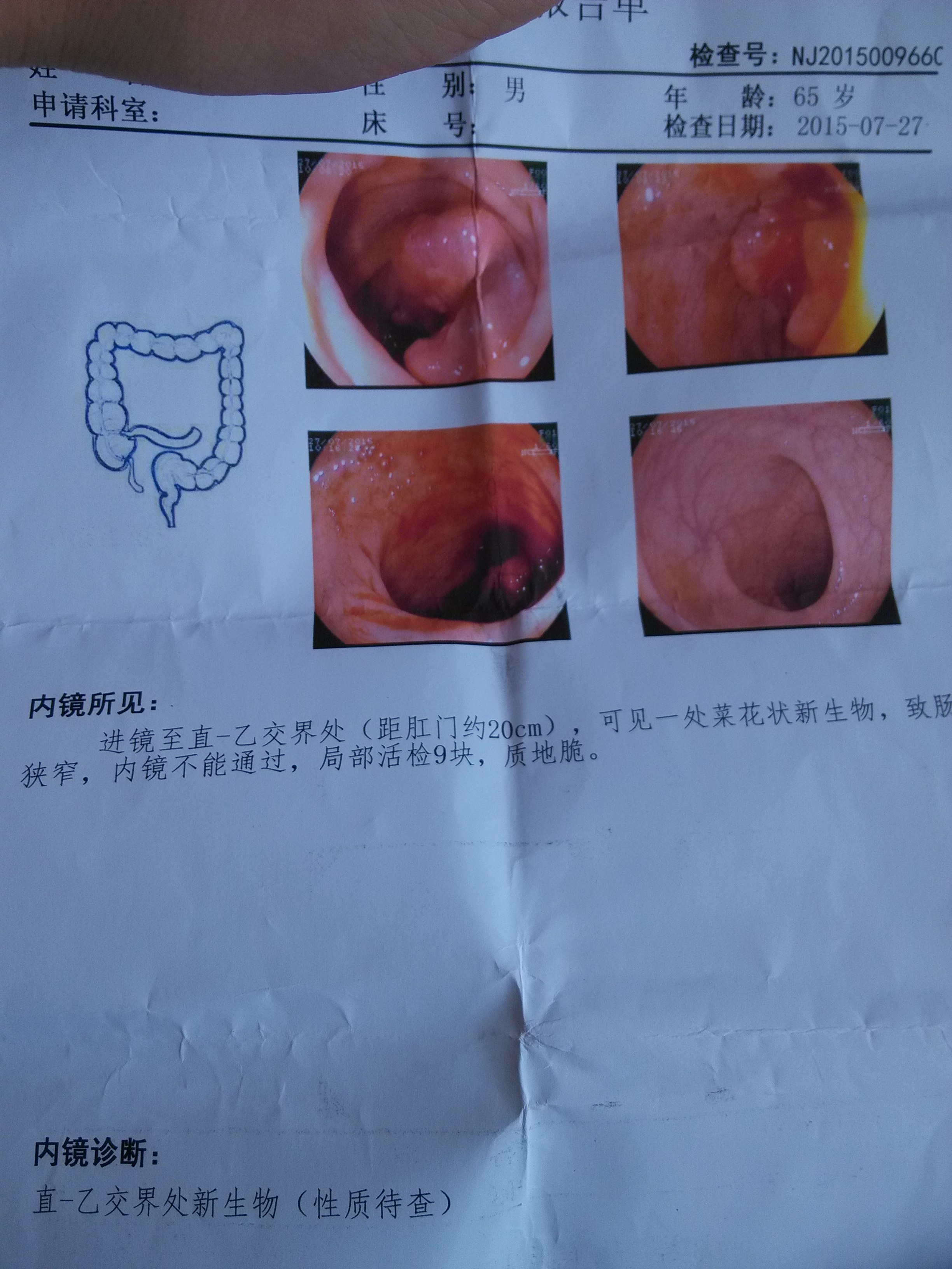 出血大便回事是怎么回事_出血大便回事是什么原因_大便出血是怎么回事吗