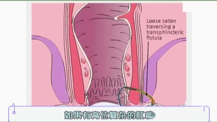 肛裂加肛瘘手术_肛裂肛瘘痔疮手术需要恢复多久_肛裂肛瘘手术治疗需要多长时间
