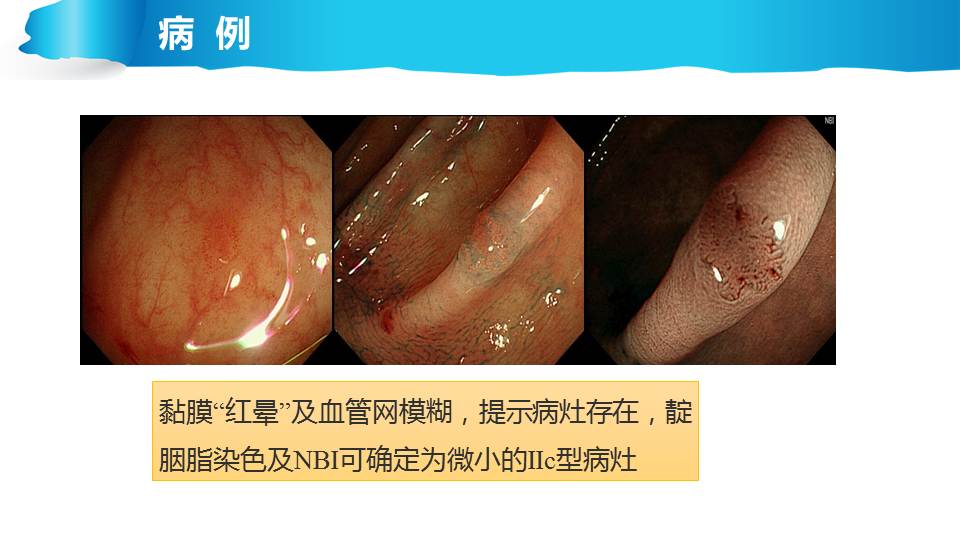 克罗恩病 内镜_克罗恩病镜下表现_克罗恩病简化内镜评分