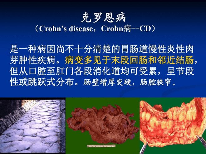 克罗恩饮食指导软件_克罗恩病膳食指南_克罗恩病的饮食
