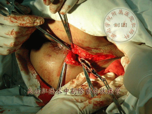 女性肛瘘手术时间_女性肛瘘手术多久可以同房_手术女性肛瘘时间多长
