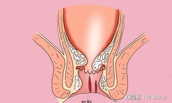 大便失禁肛门溃烂怎么办_肛门大便撕裂用什么药好_慰安妇肛门撕裂大便失禁