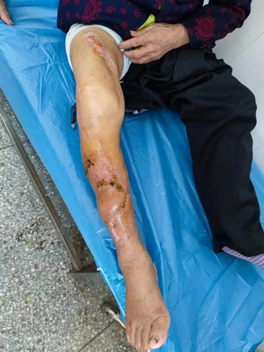肛瘘手术多久能做_做肛瘘手术多长时间能同房_做肛瘘手术后多久可以夫妻同房