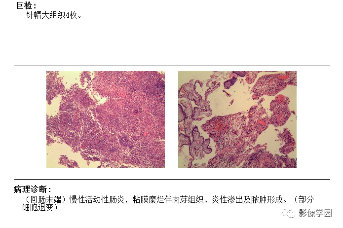 克罗恩病能遗传给下一代吗_克罗恩病是遗传_克罗恩病会不会遗传