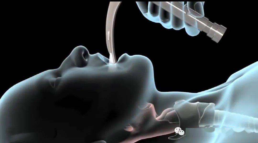 气管有炎_只气管炎_支气管炎治疗方法