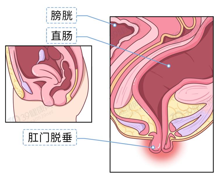 拉大便拉出鲜血_拉大便拉出好多鲜血_拉鲜血大便好多出血块