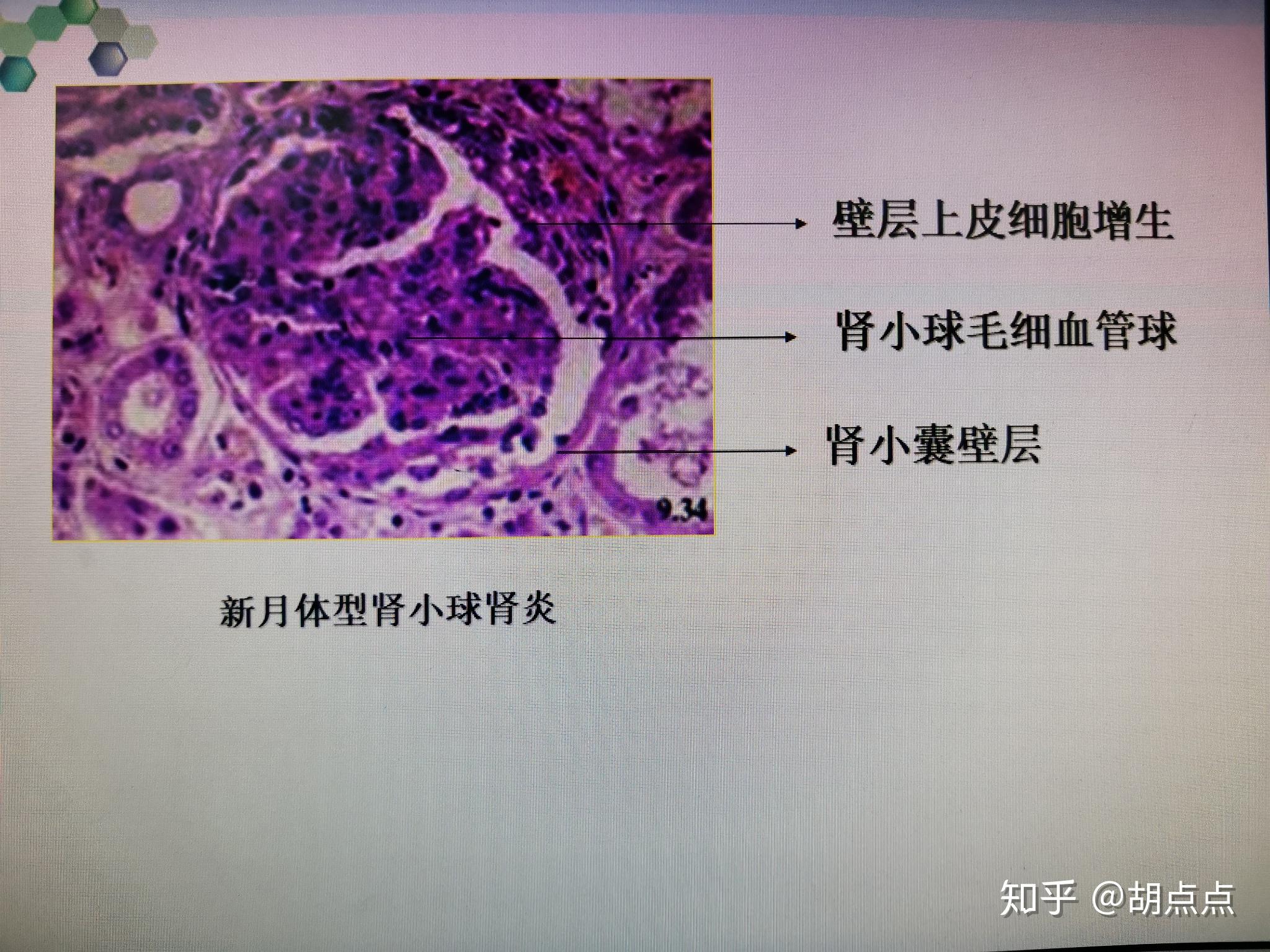继发性肺结核会治好吗_肺治结核性继发好会传染吗_继发性肺结核治愈后还会传染吗
