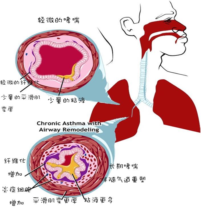 哮喘急性发作视频_急性发作期哮喘_急性哮喘发作常见诱因