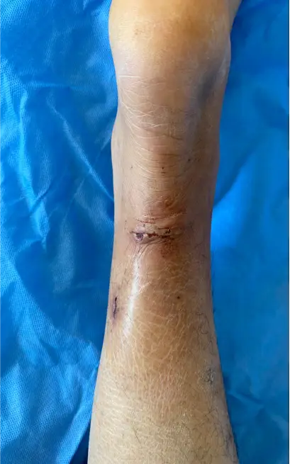 做肛瘘手术后多久可以夫妻同房_肛瘘手术多久能做_做肛瘘手术多长时间能同房