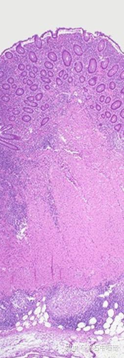 罗克罗恩病_克罗恩病能活几十年_罗克恩是什么病