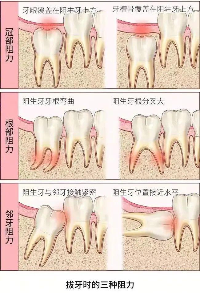 “迟来2分钟命都没了”！一次被拔9颗牙进ICU，竟因接了一通电话
