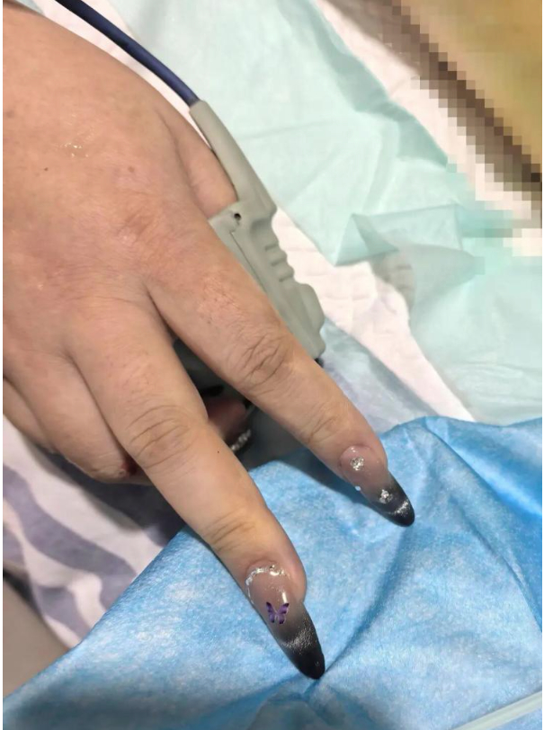 抢救室里，“医生叫来美甲师”？特别提醒：给自己留一个“救命指”