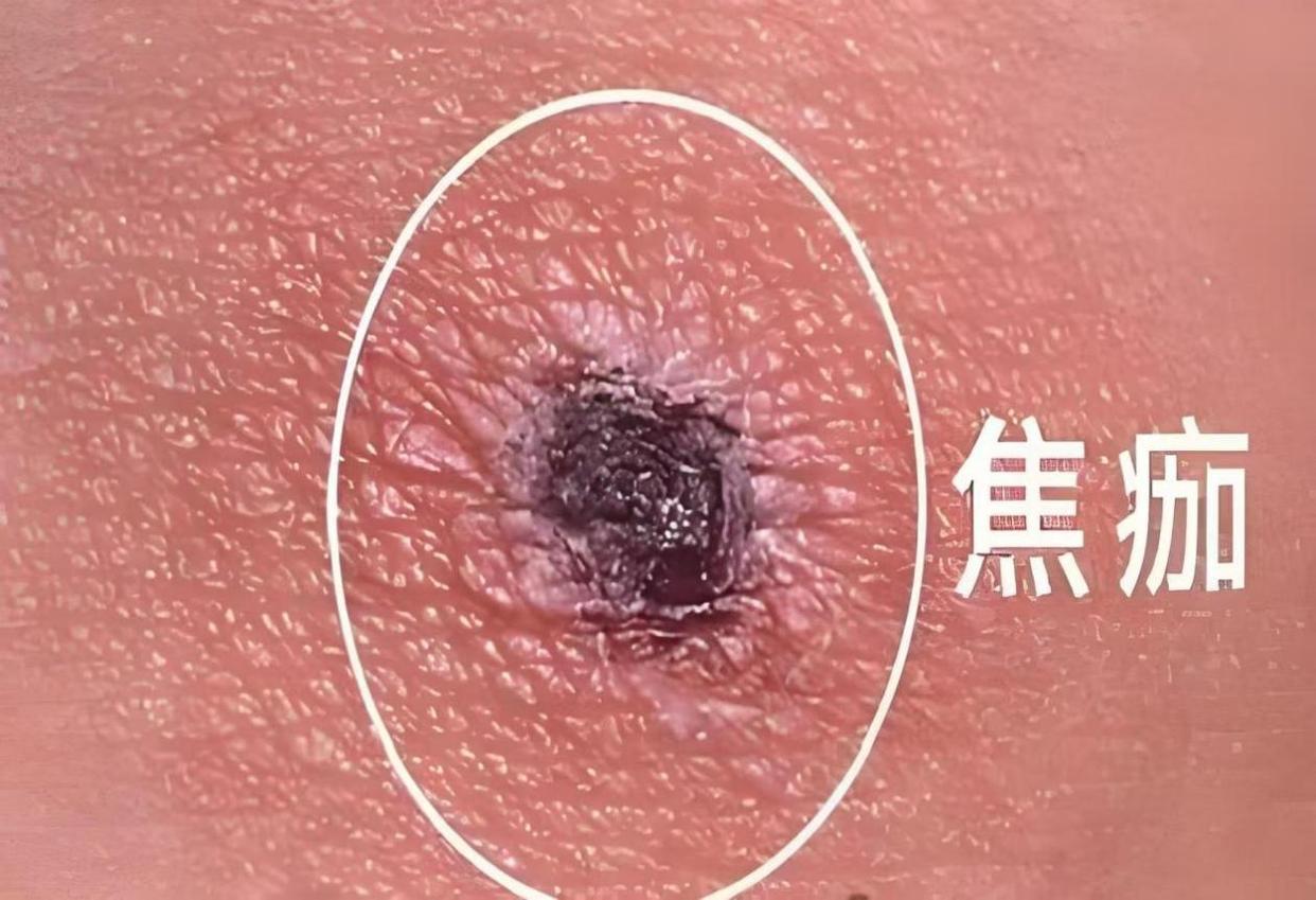 夏季户外活动 谨防这种“小虫子”