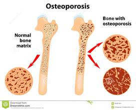 骨质疏松