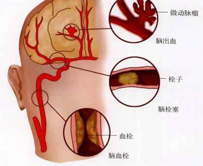 脑血栓发病前有哪些前兆