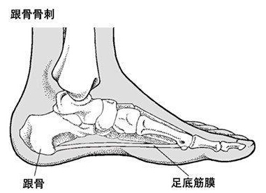 足跟痛是长骨刺了吗