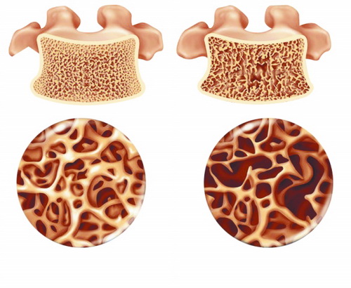 骨质疏松