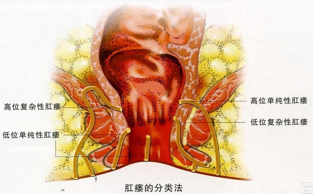 肛瘘手术恢复好了啥样子_手术恢复肛瘘时间多久_肛瘘手术恢复时间