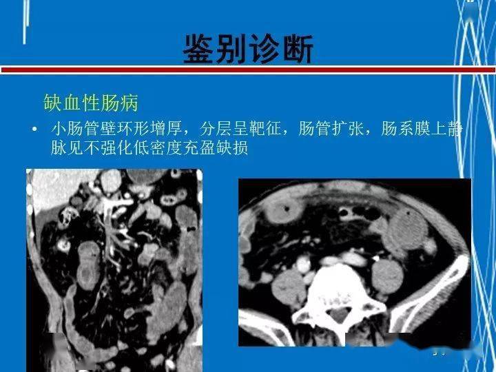 罗克恩病怎么确诊_诊断克罗恩的标准_克罗恩病完整诊断