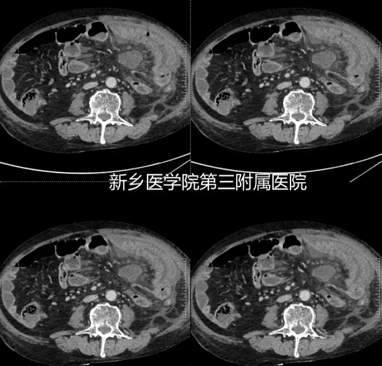 克罗恩病溃疡_克罗恩病口疮样溃疡_克罗恩病溃疡能愈合吗