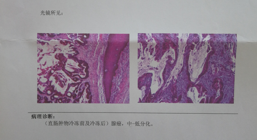 血压高冠心病_高血压冠心病能除根吗_得了冠心病高血压能活几年