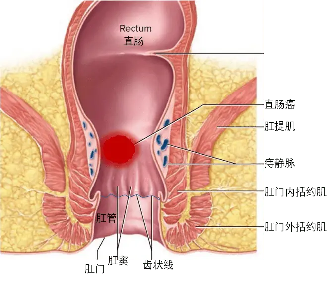 哨兵痔手术 肛门失禁 怎么办_哨兵痔手术后遗症_哨兵痔手术肛门处有刀口吗