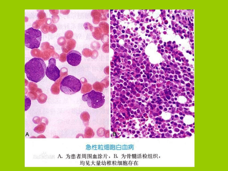 急性白血病只能活3-5个月_急性白血病活多久_急性白血病活不过3个月