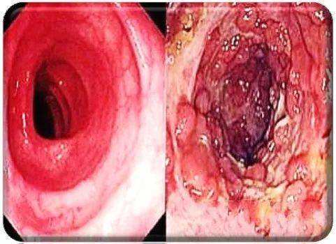 克罗恩病肠镜表现_克罗恩病肠镜病理表现_肠镜克罗恩病