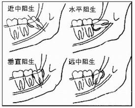 阻生智齿