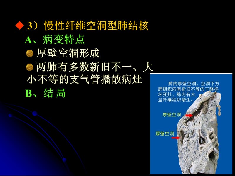 浸润型肺结核属于几型_浸润性肺结核属于哪型_浸润型肺结核属于几型肺结核