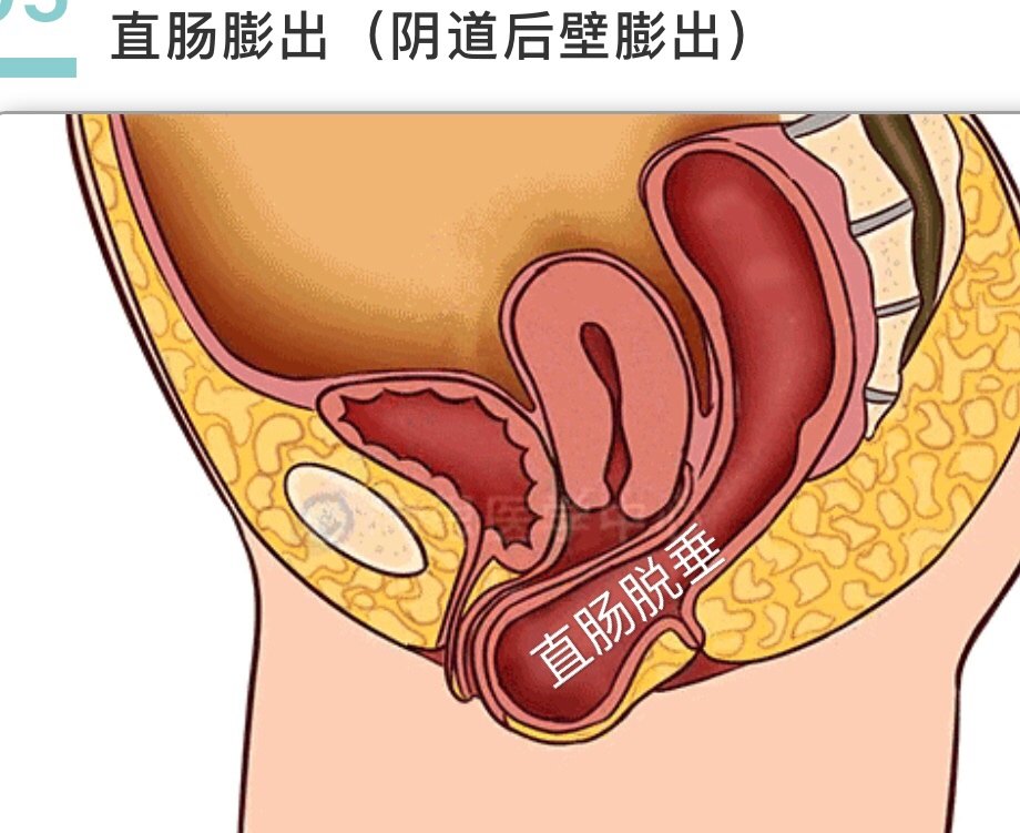 肛肠脱垂肛门失禁_肛门脱垂严重的会怎样_肛门垂脱需要手术吗