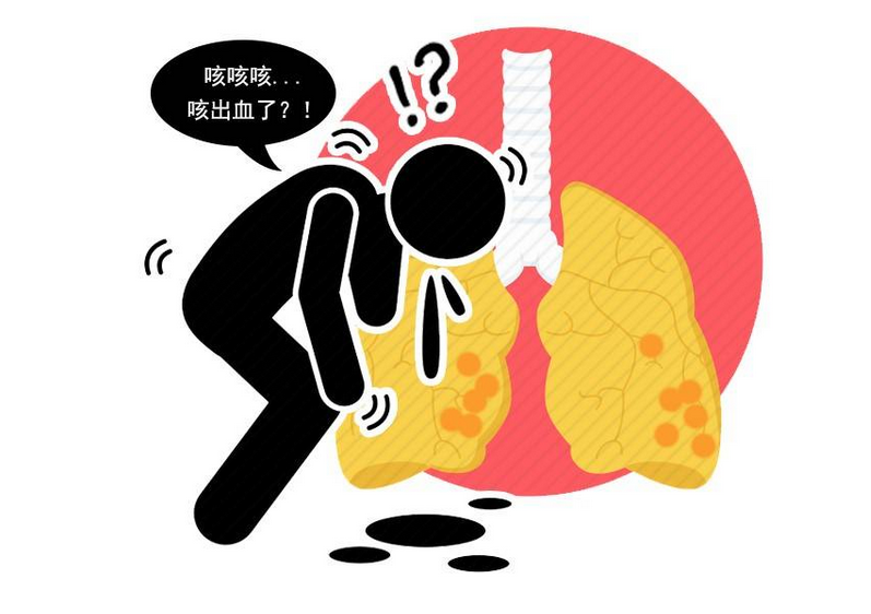 肺结核的严重症状是什么_肺结核严重性分几个程度_三型肺结核严重吗