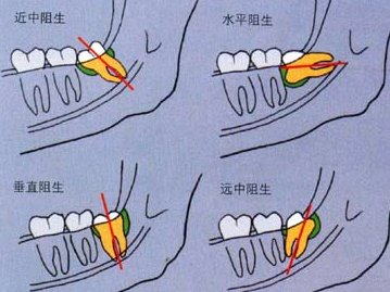 智齿容易破坏临牙