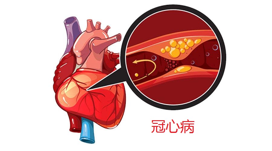 护理病人冠心病问题有哪些_冠心病病人的护理问题_护理病人冠心病问题分析